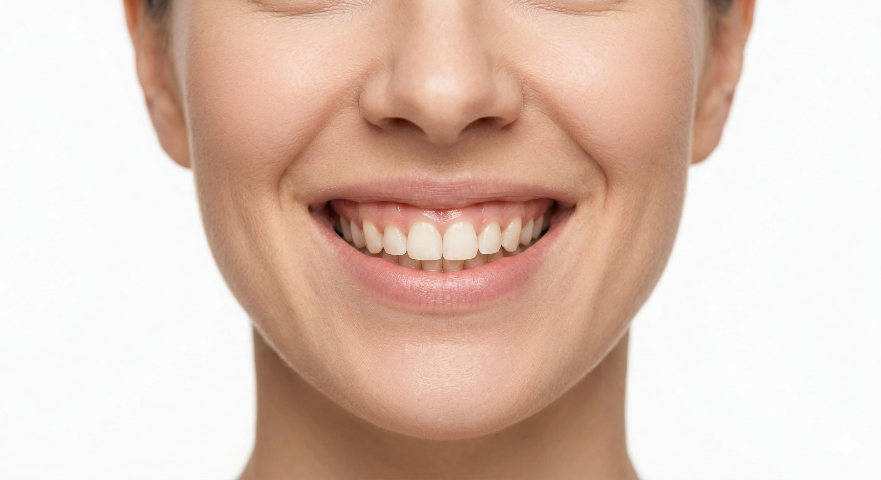 Gummy Smile (Diş Eti Gülüşü) Tedavisi